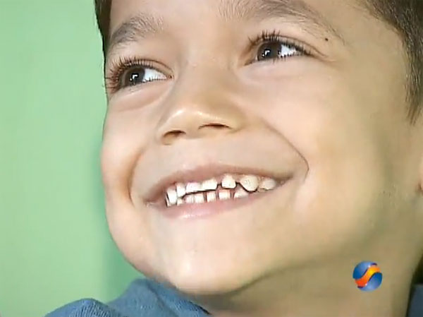 Criança de 5 Anos Tem Oito Dedos no Pé Direito Criança de 5 Anos Tem Oito Dedos no Pé Direito